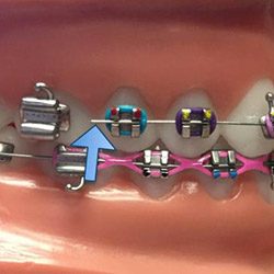 braces wire