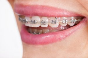 Common Signs You Need an Emergency Orthodontist