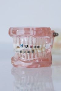 Model of traditional metal braces at orthodontist