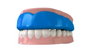 Model of mouthguard over teeth