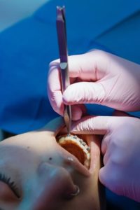 Orthodontist applying elastics to braces